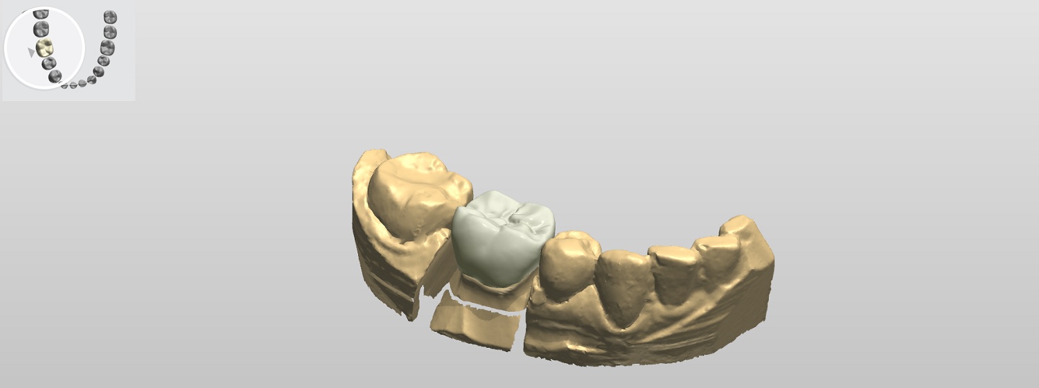 CAD/CAM design with 3Shape Dental Designer by highly experienced technicians