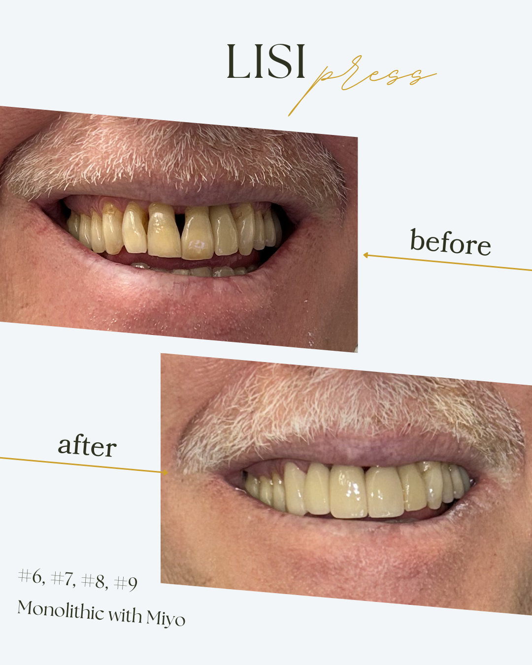 Before and after #6, #7, #8, #9 LiSi Press crowns with MiYO