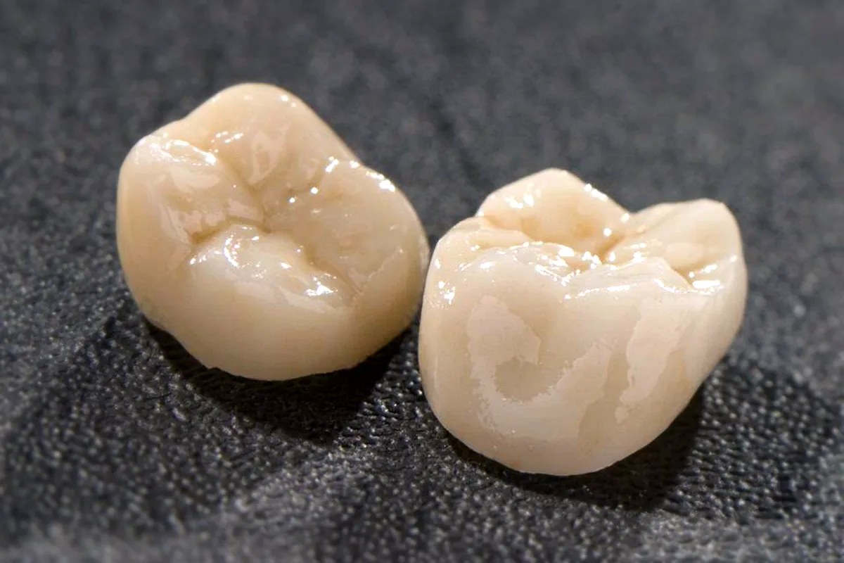 Dental crown restorations fabricated by Rohling Dental Laboratory