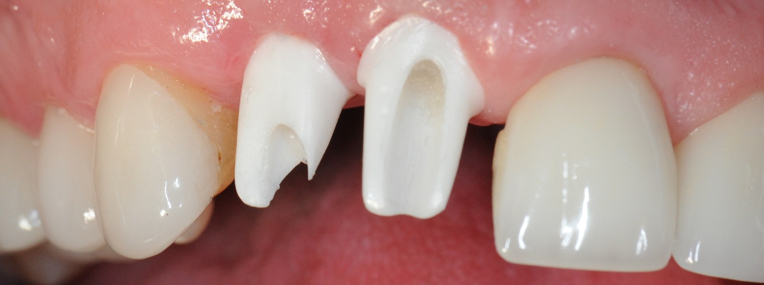 Custom Zirconia Hybrid Implant Abutments Places at Tooth 6 and 7